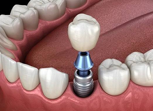 Dental Implant