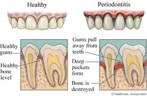 Periodontist in San Antonio