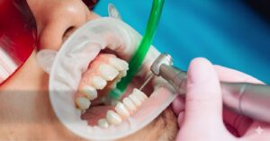 Deep Teeth Cleaning