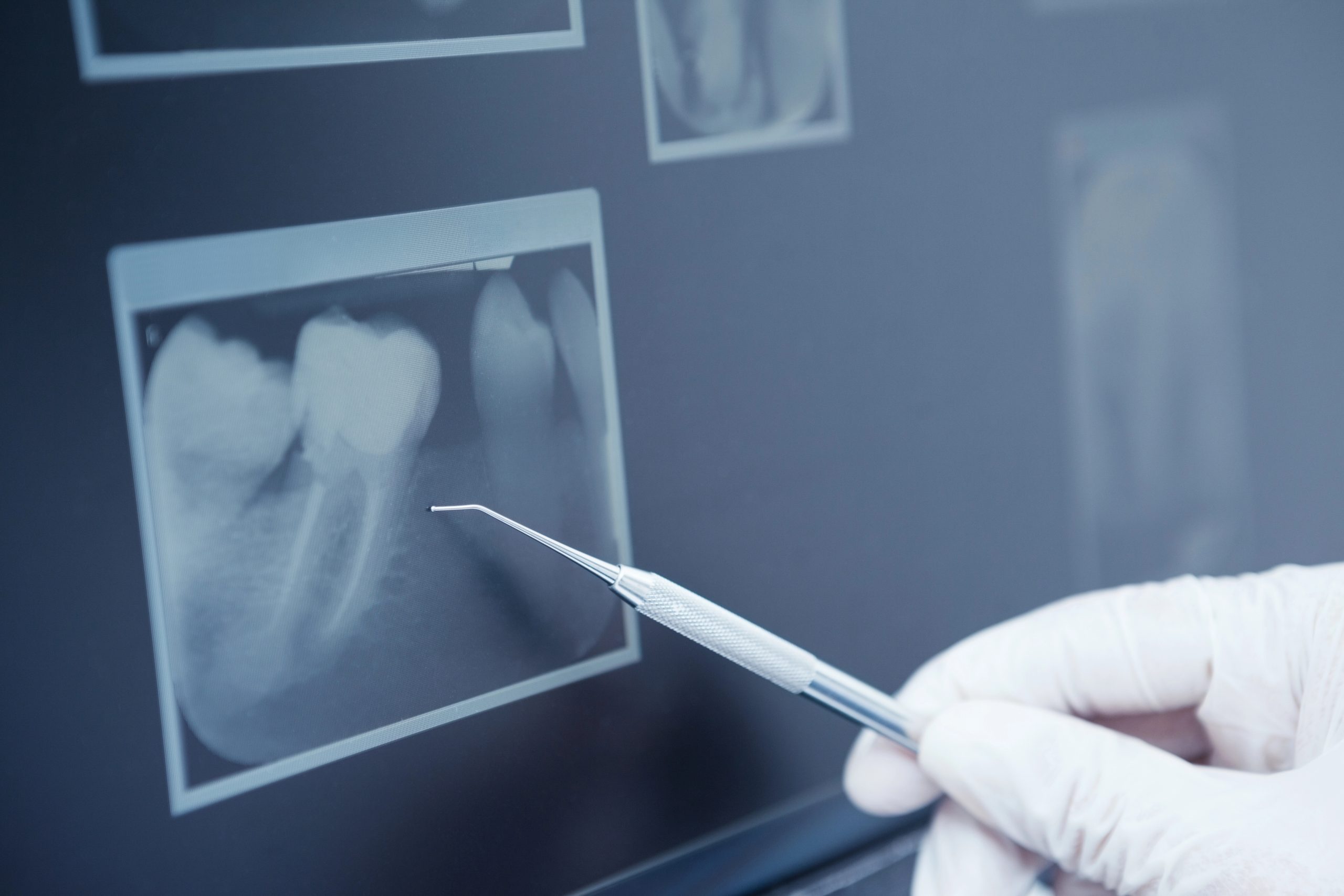 Why Are Dental X-Rays Essential for Your Oral Health in San Antonio?