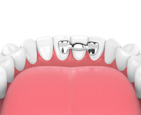 How Long Can a Dental Bridge Last? What San Antonio, TX Patients Should Know