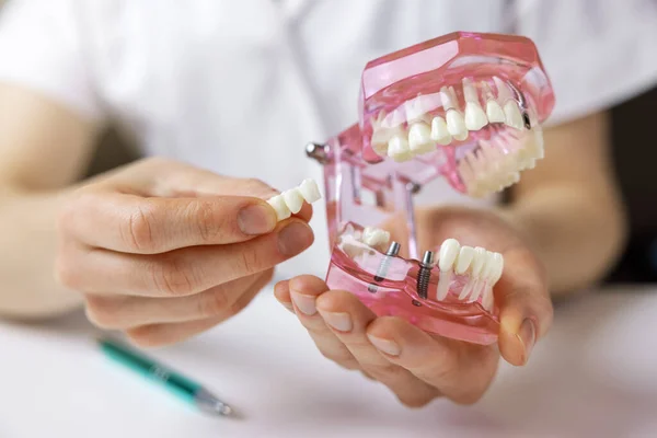 What to Expect During a Dental Bridge Procedure in San Antonio, TX