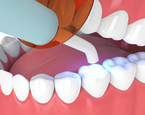 Do You Need a Tooth Filling in San Antonio, TX? Signs You Shouldn’t Ignore