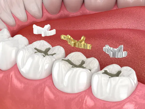 How Long Tooth Fillings Last: What San Antonio, TX Patients Should Know