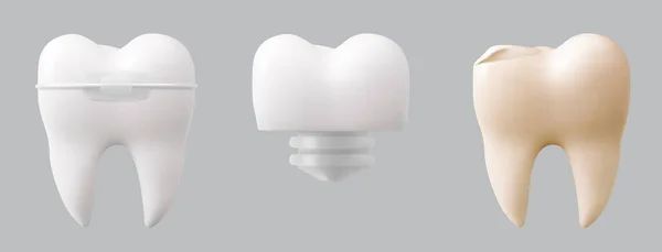How Long Will Your Dental Crown Last and What Can You Do to Protect It?